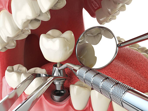 Best Emergency Tooth Extraction in Dexter, MO